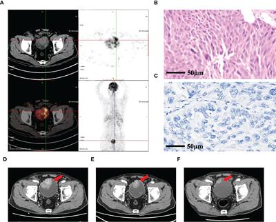 Case Report: PD-L1-negative advanced bladder cancer effectively treated with anlotinib and tislelizumab: A report of two cases